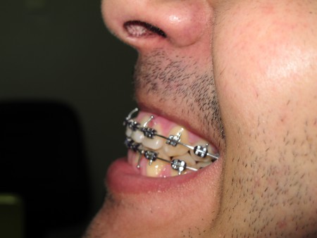 Prognatismo mandibular.pós operatório.JPG