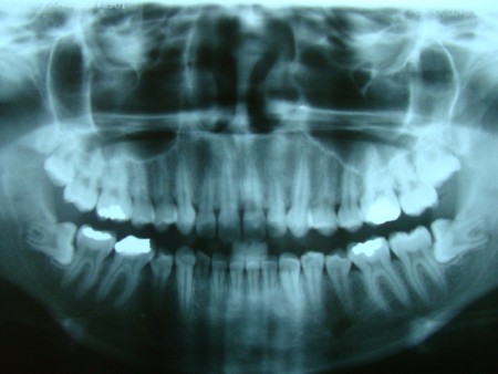 Inclusão dental horizontal.JPG
